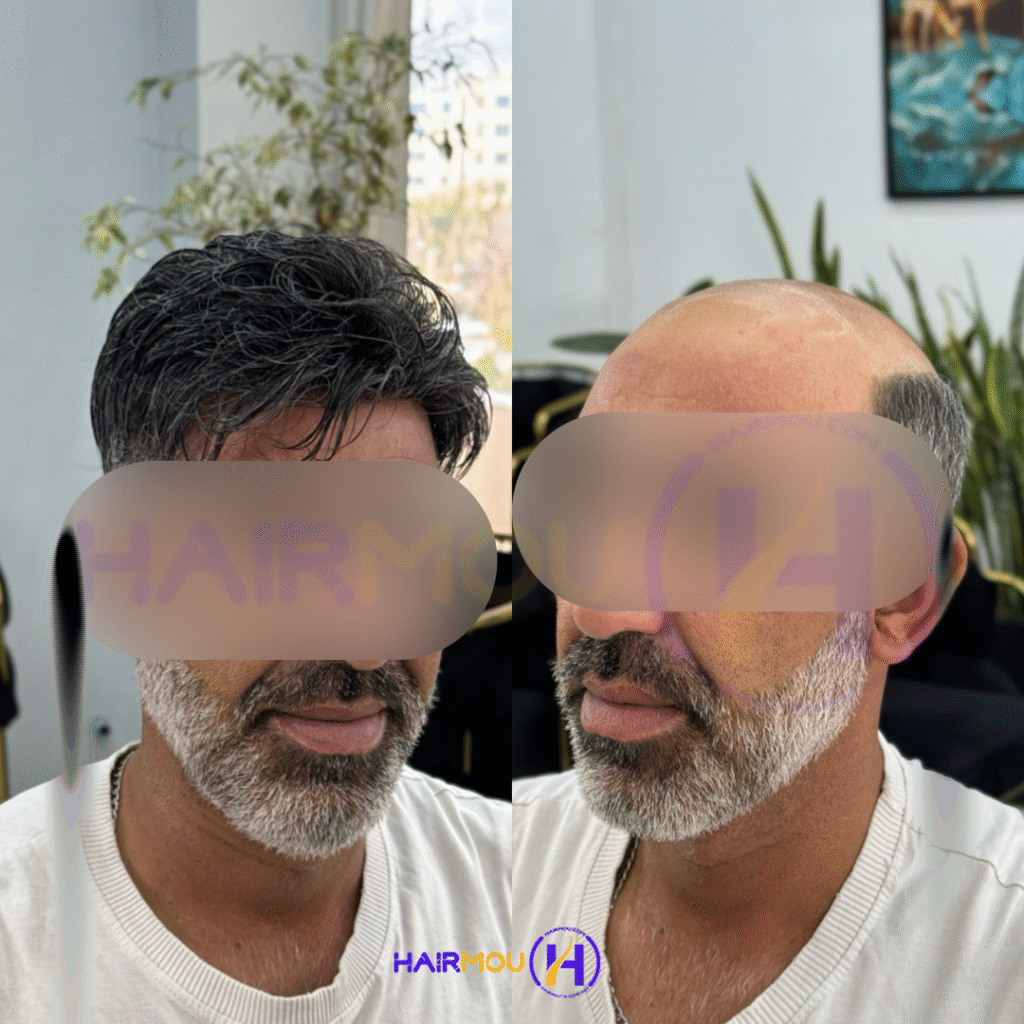 پروتزمو جوگندمی کلینیک هیرمو