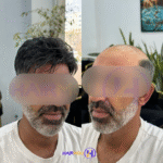پروتزمو جوگندمی کلینیک هیرمو
