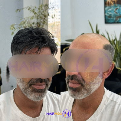 پروتزمو جوگندمی کلینیک هیرمو