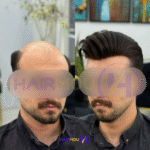 پروتز مو هشت تکه درجه 2 هیرمو