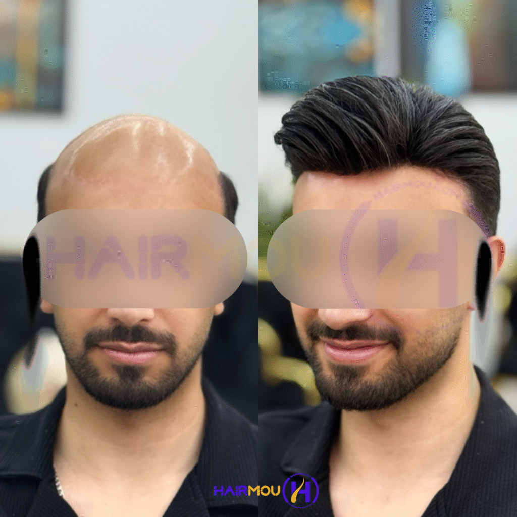 پروتز مو هالیوودی درجه 1 ساخت چین کلینیک هیرمو