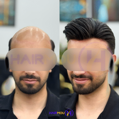 پروتز مو هالیوودی درجه 1 ساخت چین کلینیک هیرمو