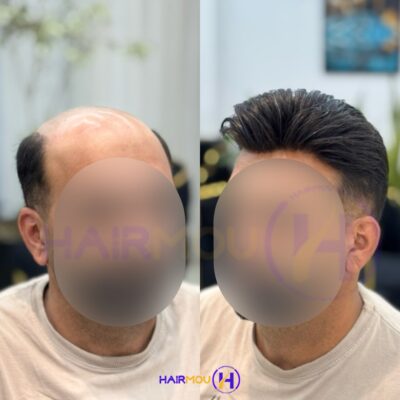 پروتز انکارایی درجه یک ساخت چین کلینیک هیرمو