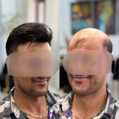 پروتز مو هالیودی درجه 2 هیرمو