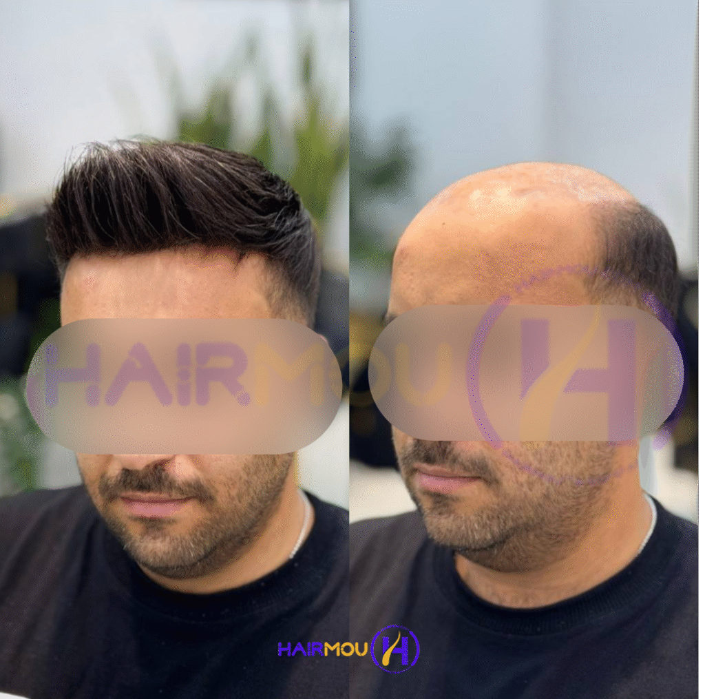 پروتز مو دور سیلیکونی نیوزیلندی درجه 2
