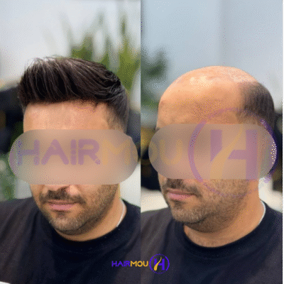 پروتز مو دور سیلیکونی نیوزیلندی درجه 2