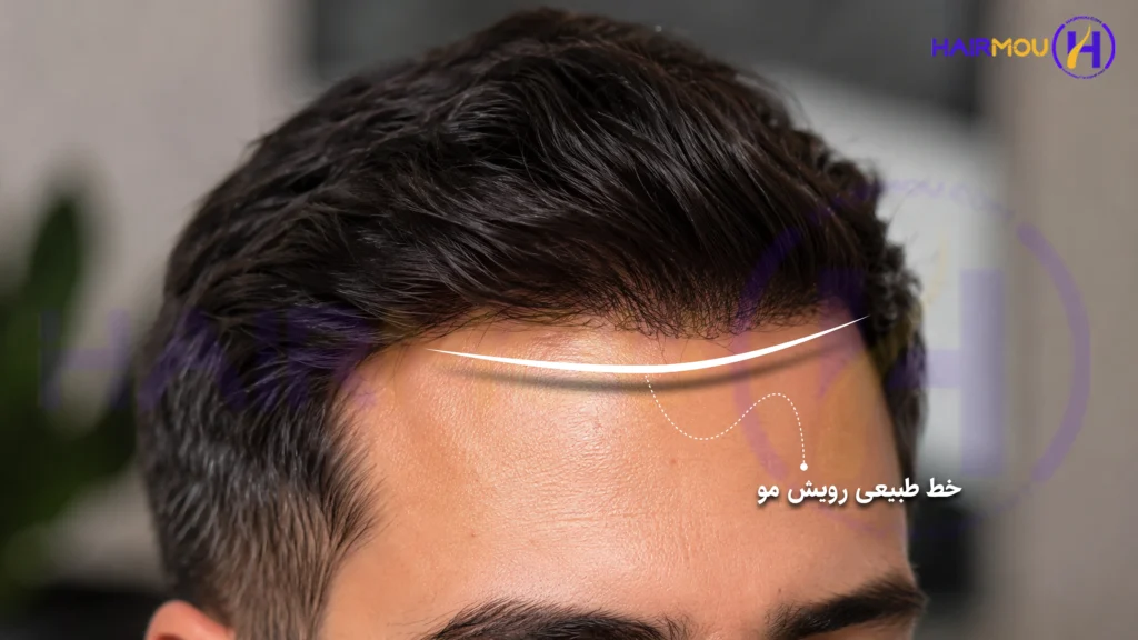 بهترین پروتز مو در شیراز