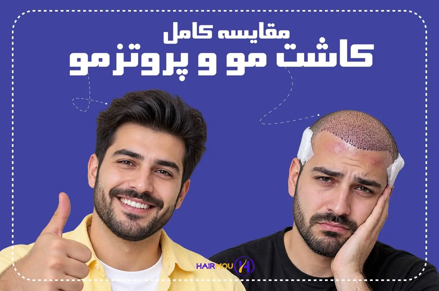 مقایسه کاشت مو و پروتز مو