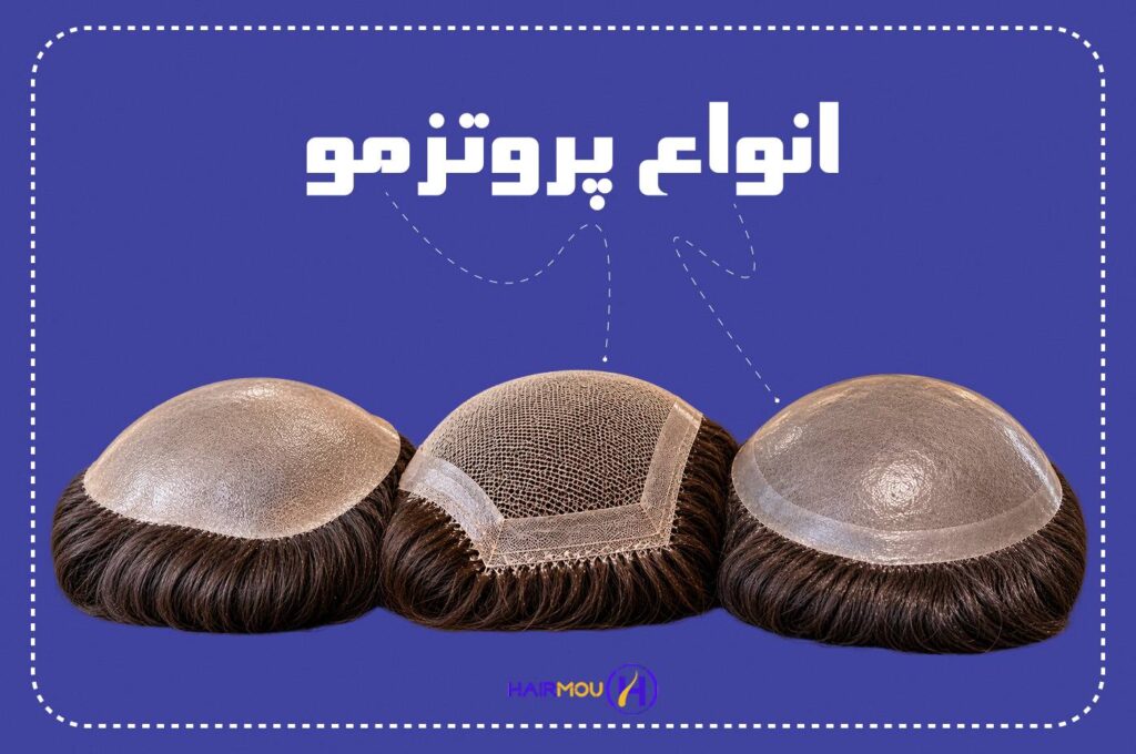 انواع پروتز مو