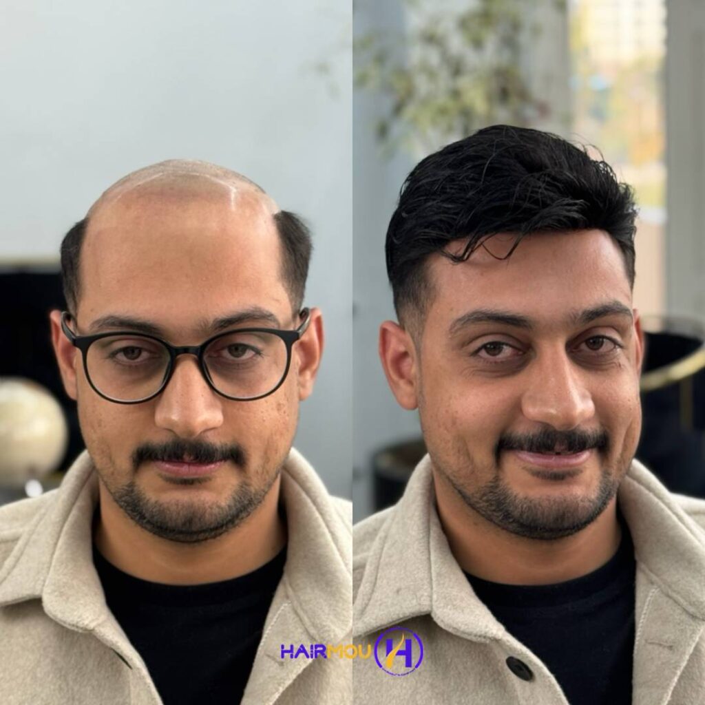 قیمت پروتز مو مردانه