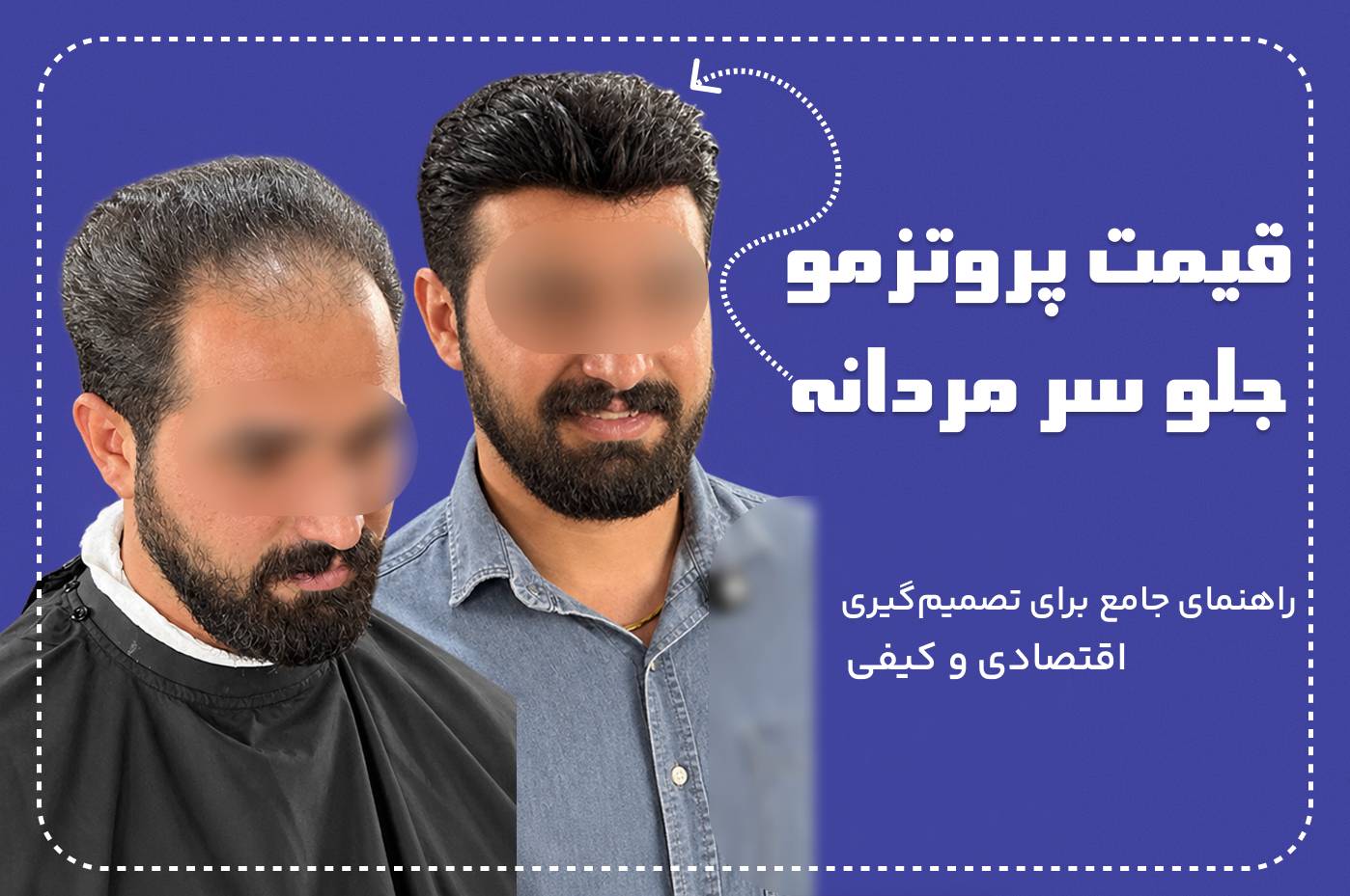 قیمت پروتز مو جلو سر مردانه