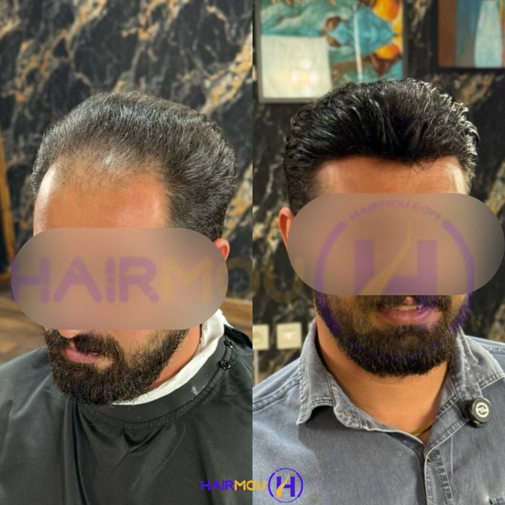 قیمت پروتز مو جلو سر مردانه