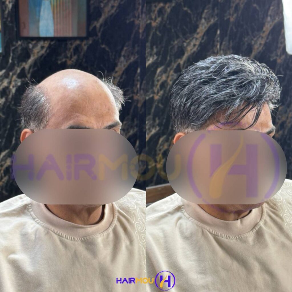 قیمت پروتز مو جلو سر مردانه