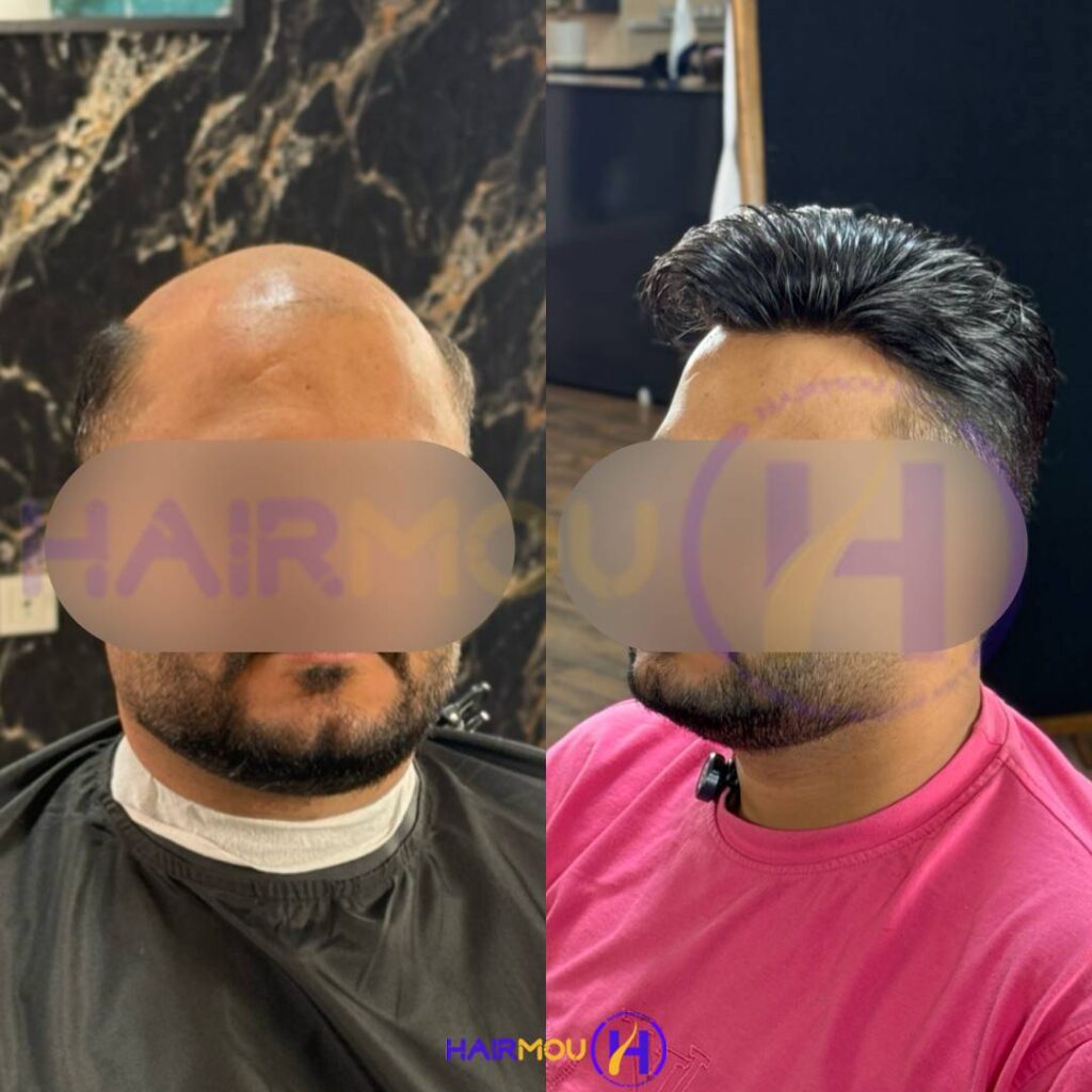 قیمت پروتز مو جلو سر مردانه