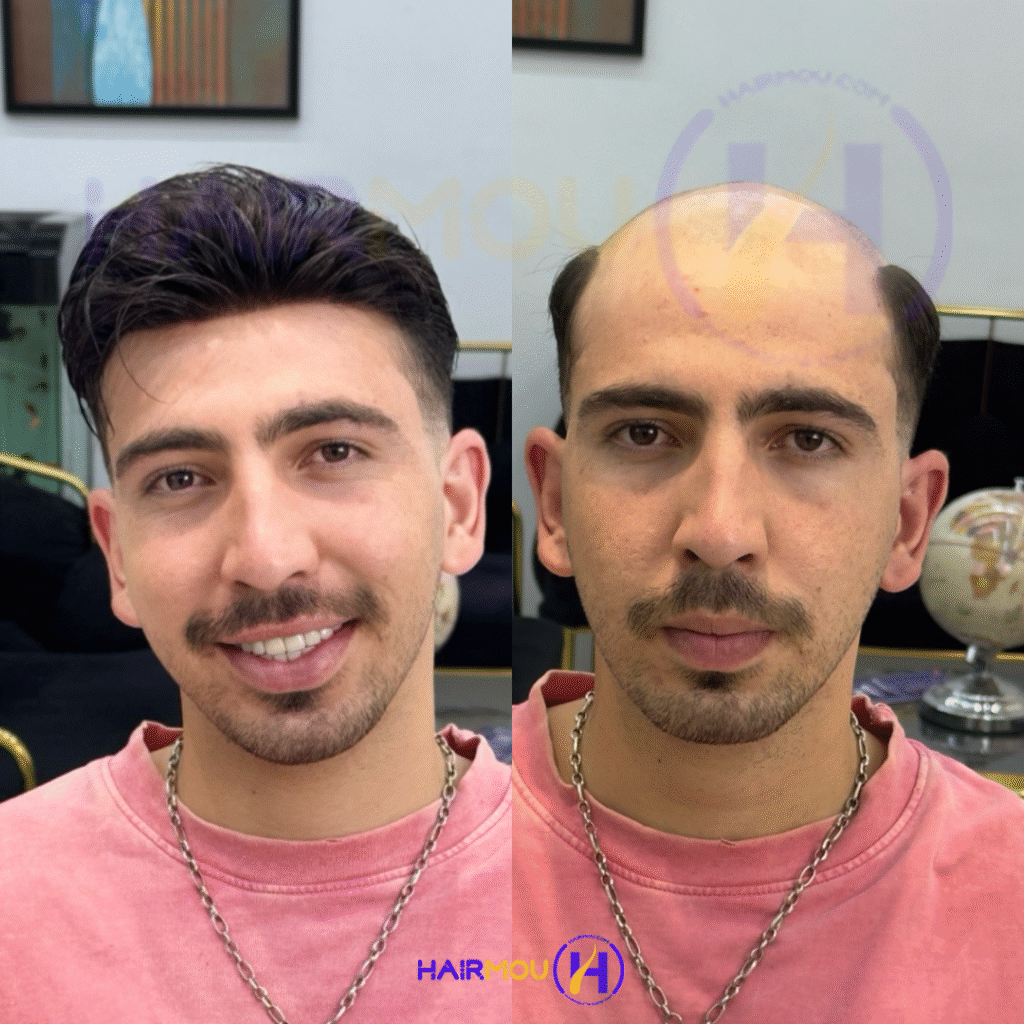 فروش پروتز مو مردانه