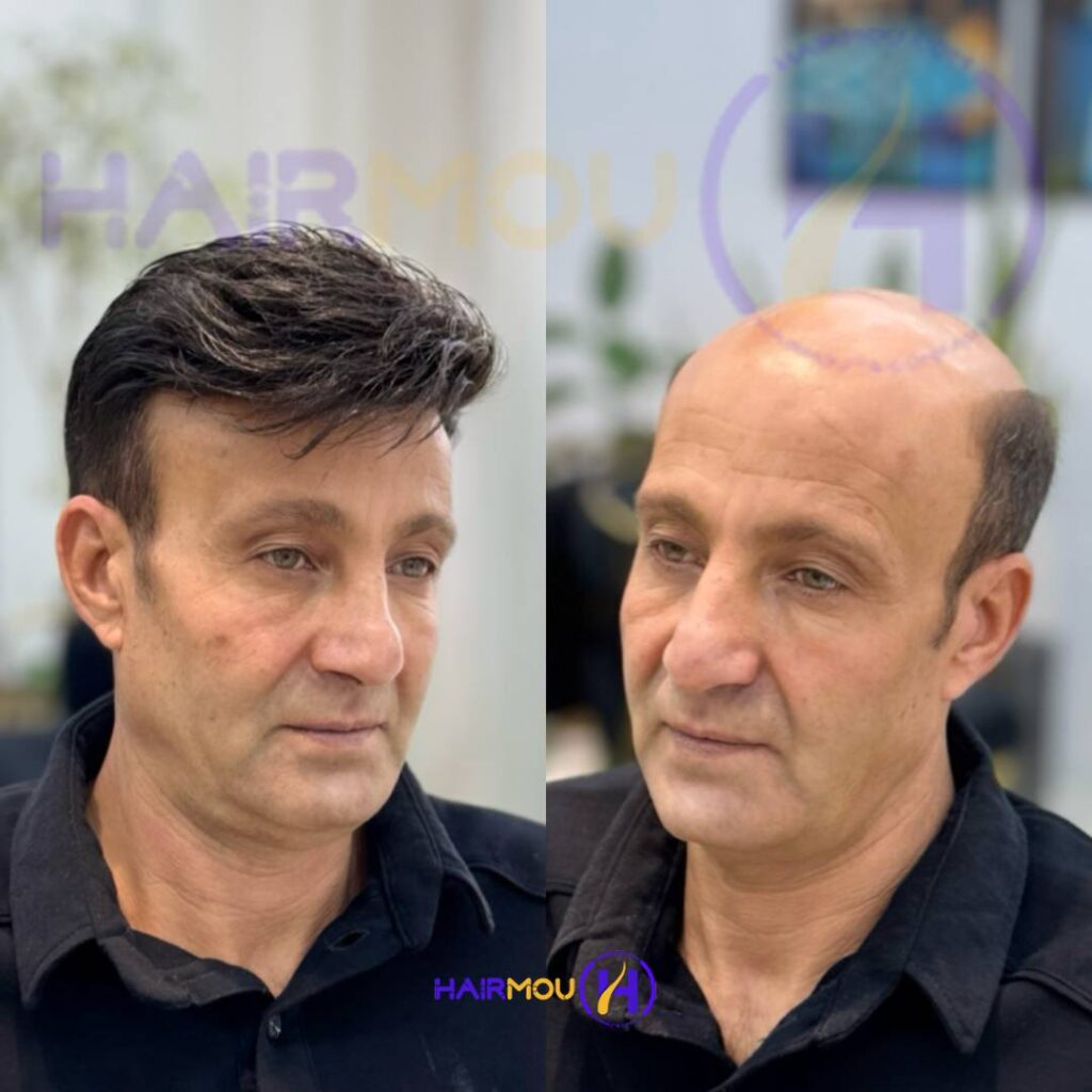 قیمت پروتز مو مردانه
