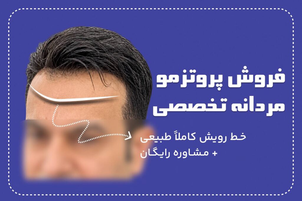 فروش پروتز مو مردانه
