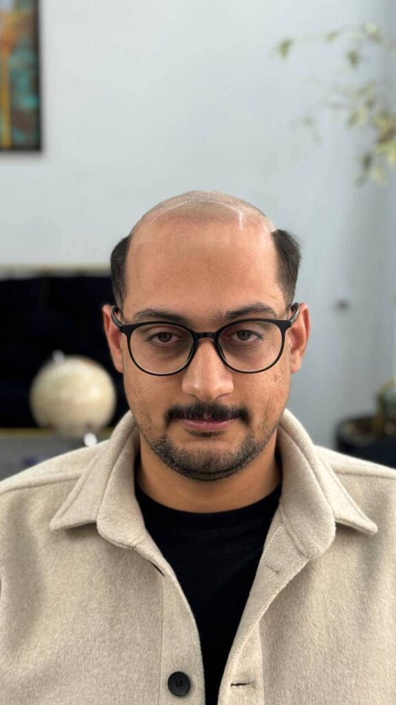 قیمت پروتز مو مردانه